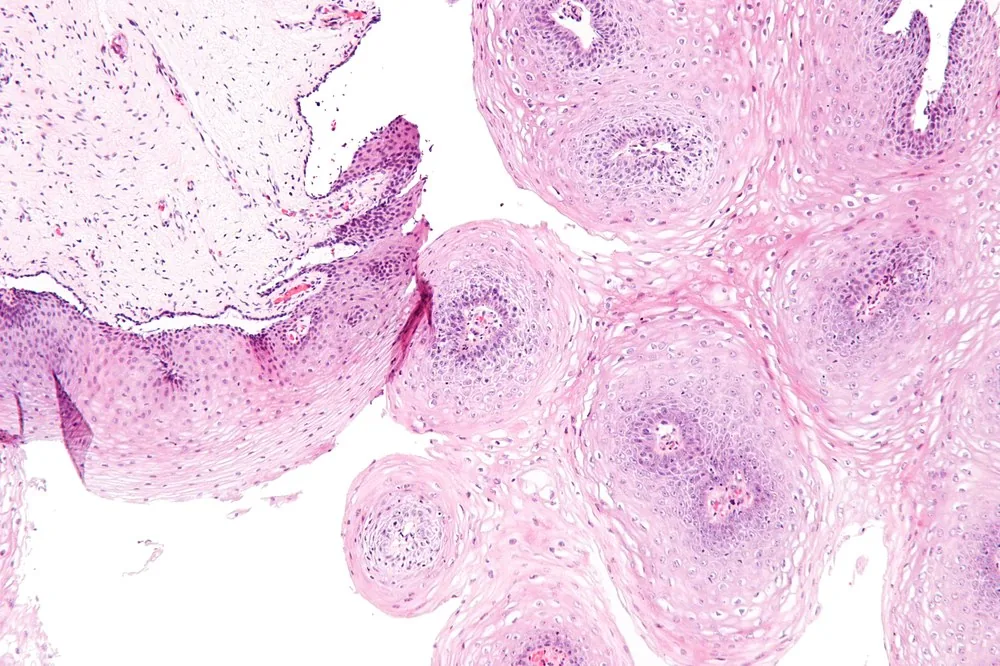 Anogenital warts (condylomata acuminata) – Colposcopy: Ectopy/ectropion in a nullipara — red columnar epithelium around the os with a sharp squamous border