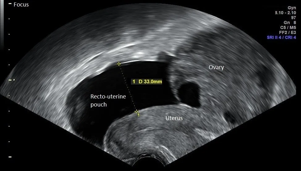 Corpus-luteum-Zyste und hämorrhagische Ovarialzyste – Sonographie: Komplexe zystisch-solide Adnexraumforderung — Tuboovarialabszess