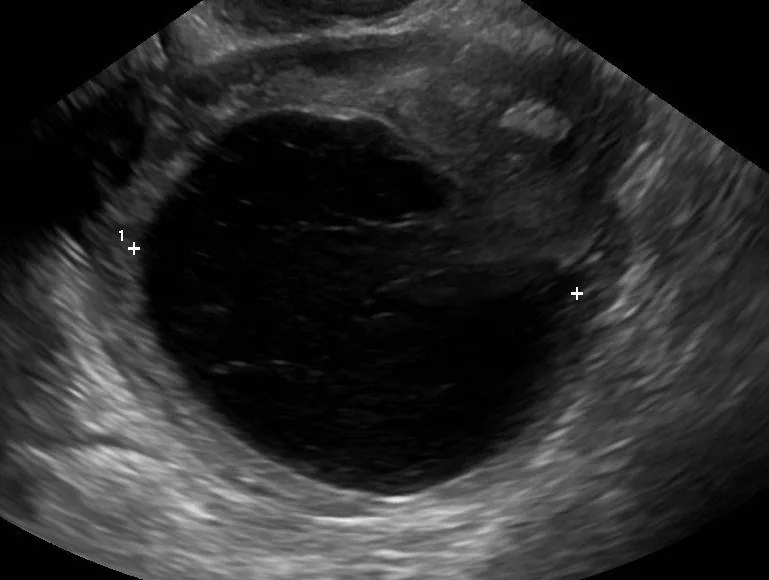 Corpus-luteum-Zyste und hämorrhagische Ovarialzyste – Sonographie: Freie Flüssigkeit im Douglas-Raum neben Uterus und Ovar