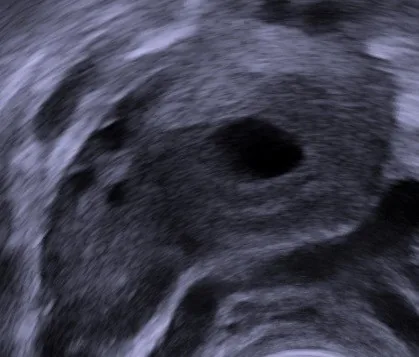 Corpus-luteum-Zyste und hämorrhagische Ovarialzyste – Sonographie: Transvaginalsonographie: hämorrhagische Ovarialzyste mit retrahiertem Koagel