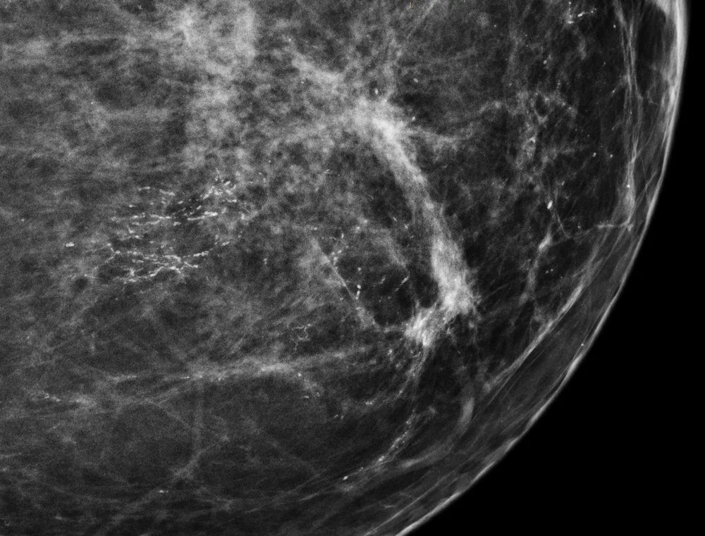 Ductal carcinoma in situ (DCIS) – Mammography/MRI: Mammogram (CC detail view): clustered, pleomorphic microcalcifications in a ductal distribution — histologically DCIS