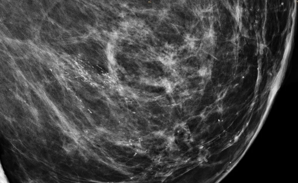 Ductal carcinoma in situ (DCIS) – Clinical