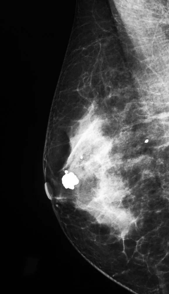 Ductal carcinoma in situ (DCIS) – Mammography/MRI: Mammogram MLO view: coarse 'popcorn' calcification of a calcified fibroadenoma — BI-RADS 2