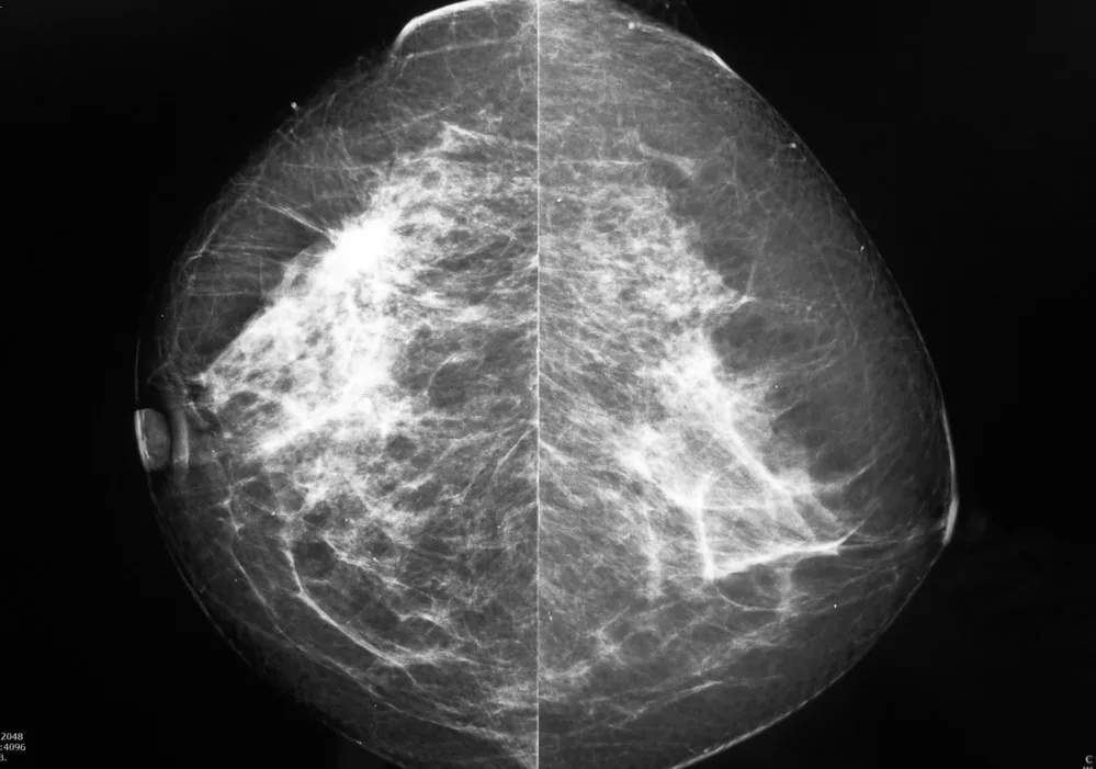 Ductal carcinoma in situ (DCIS) – Clinical