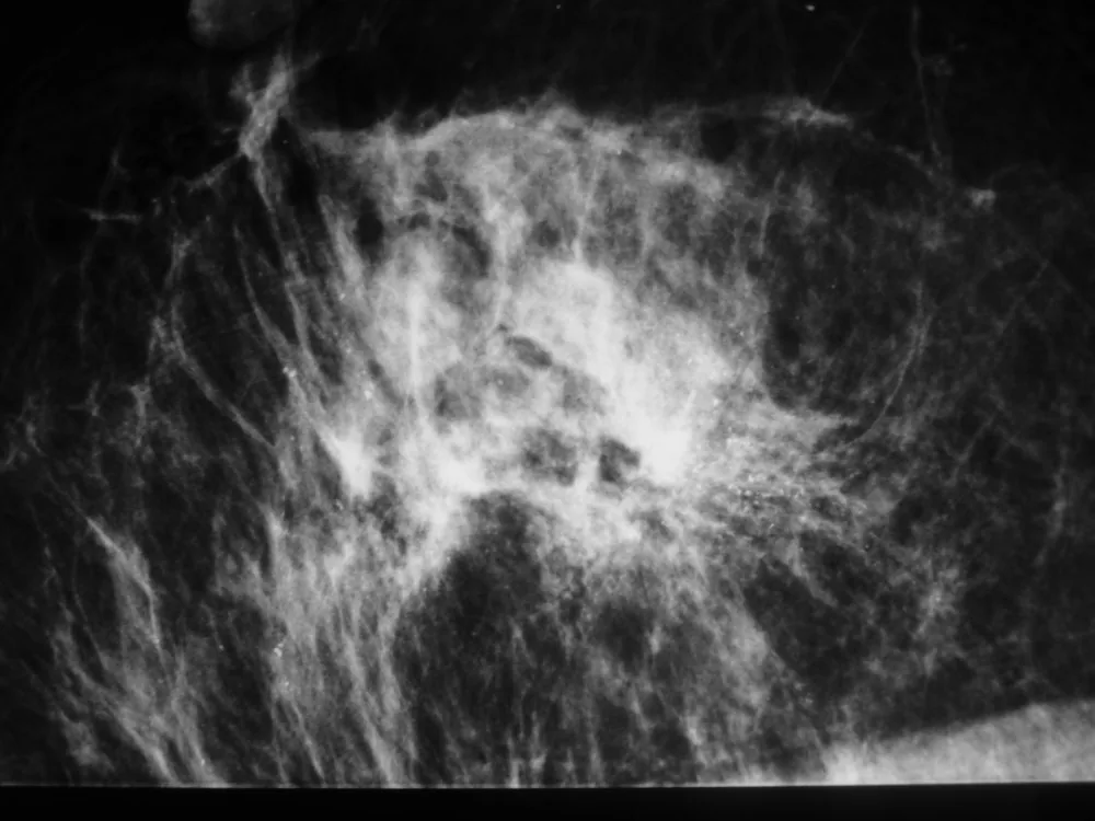 Ductal carcinoma in situ (DCIS) – Clinical