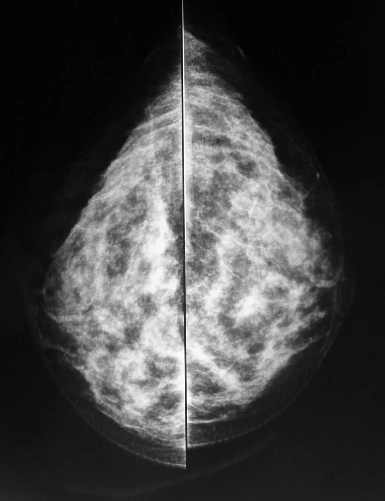 Ductal carcinoma in situ (DCIS) – Clinical