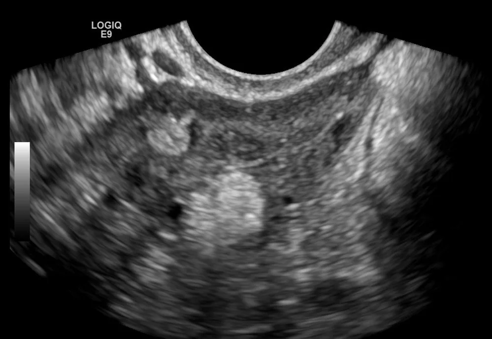 Reifes zystisches Teratom (Dermoidzyste) – Klinik: Ovarialtumor — Dermoid / reifes Teratom mit echoreichem Rokitansky-Knoten