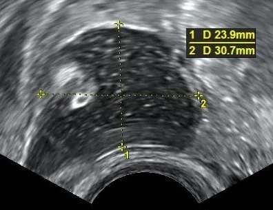 Mature cystic teratoma (dermoid cyst) – Ultrasound: Mature teratoma (dermoid)