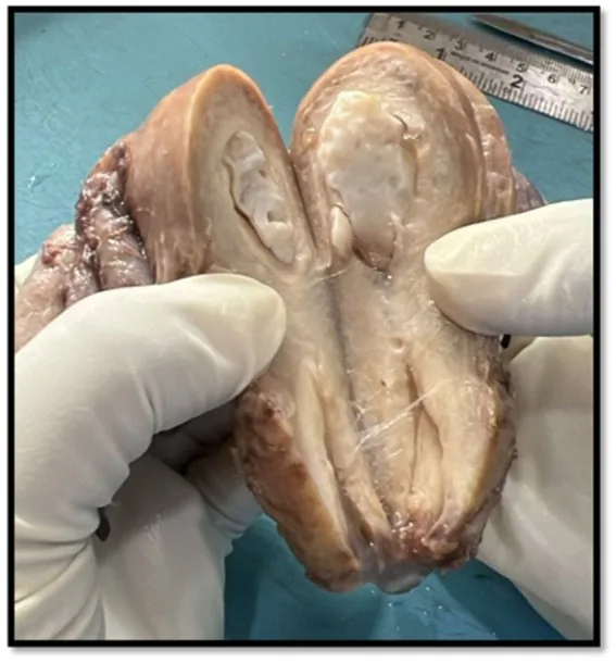 Mature cystic teratoma (dermoid cyst) – Endoscopy & gross