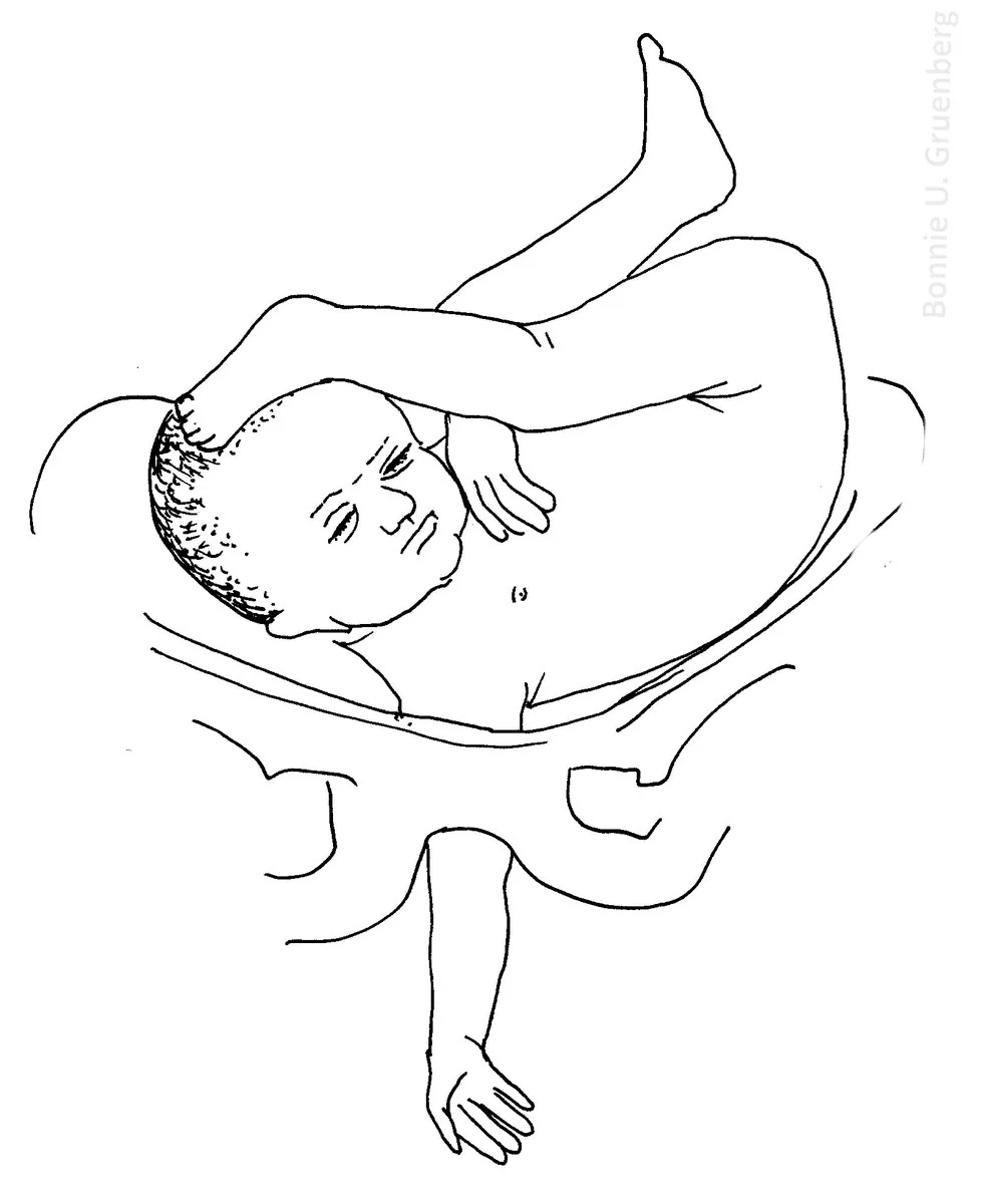 Malposition and malpresentation of the fetal head – Diagram: Diagram: shoulder-arm presentation in a transverse fetal lie