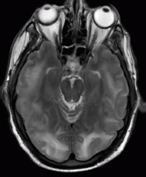 Eclampsia – Mammography/MRI: MRI (T2, axial): posterior reversible encephalopathy syndrome (PRES) with bilateral occipital cortico-subcortical hyperintensities – the typical imaging pattern in eclampsia