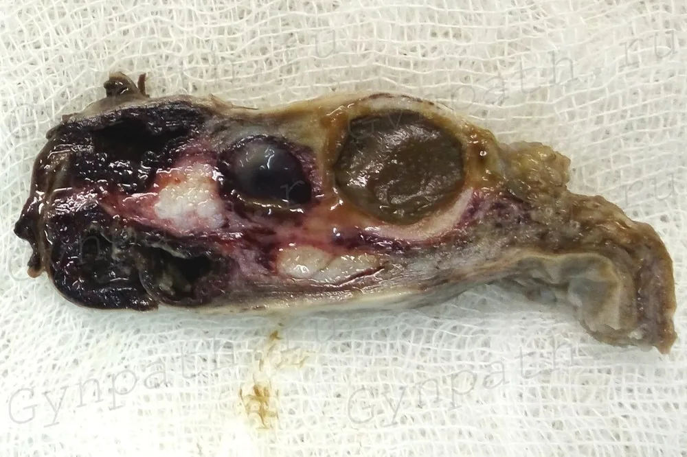Endometriom (Schokoladenzyste) – Endoskopie & Makro: Ovar mit Endometriosezysten im makroskopischen Schnitt (Schokoladenzysten)