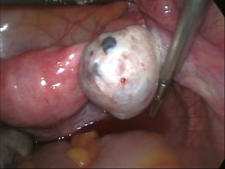 Endometriosis – Endoscopy & gross