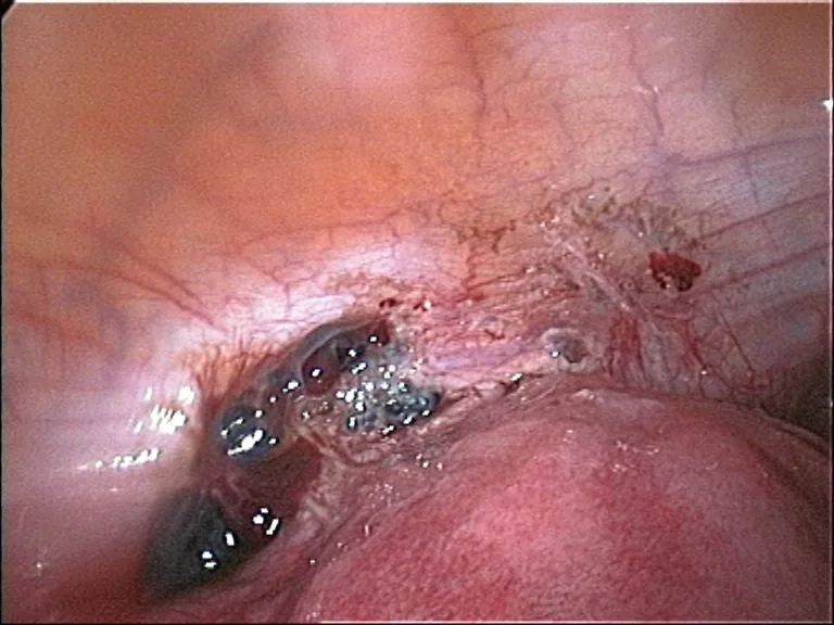 Endometriosis – Endoscopy & gross