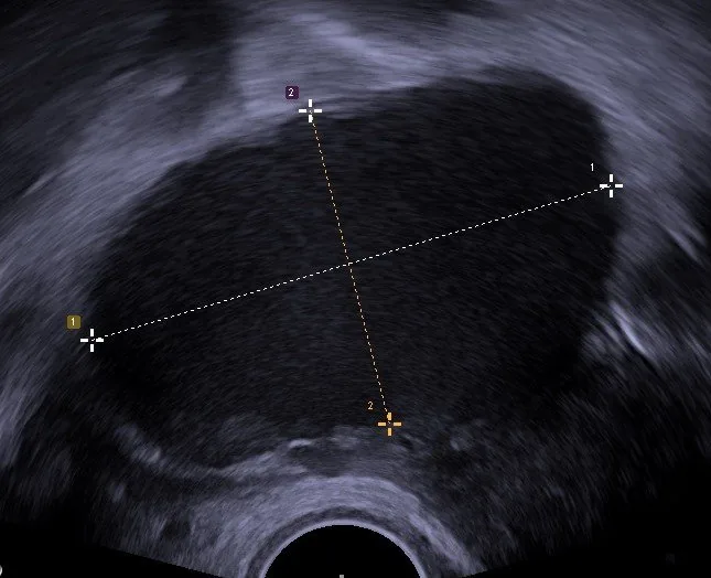 Endometriosis – Ultrasound: Transvaginal ultrasound: homogeneously hypoechoic cyst with ground-glass echogenicity — endometrioma