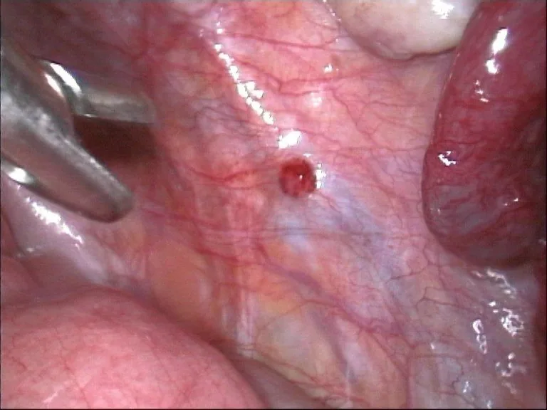 Endometriosis – Endoscopy & gross: Laparoscopy: red, well-vascularised endometriotic lesion on the peritoneum