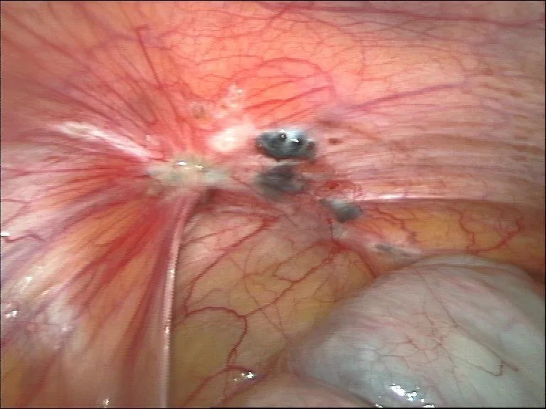 Endometriosis – Endoscopy & gross: Laparoscopy: black-blue lesions with stellate scar retraction on the peritoneum and omentum