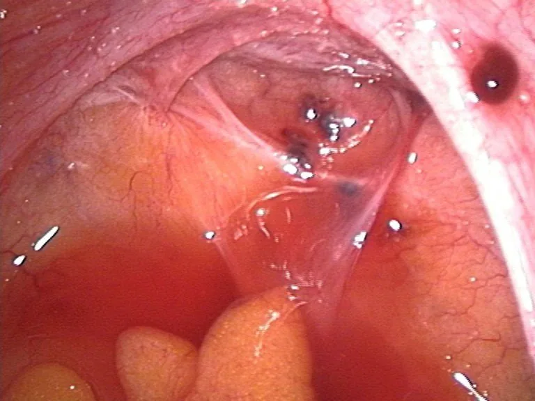 Endometriosis – Endoscopy & gross: Laparoscopy: Endometriotic lesions in the pouch of Douglas and on the right sacrouterine ligament