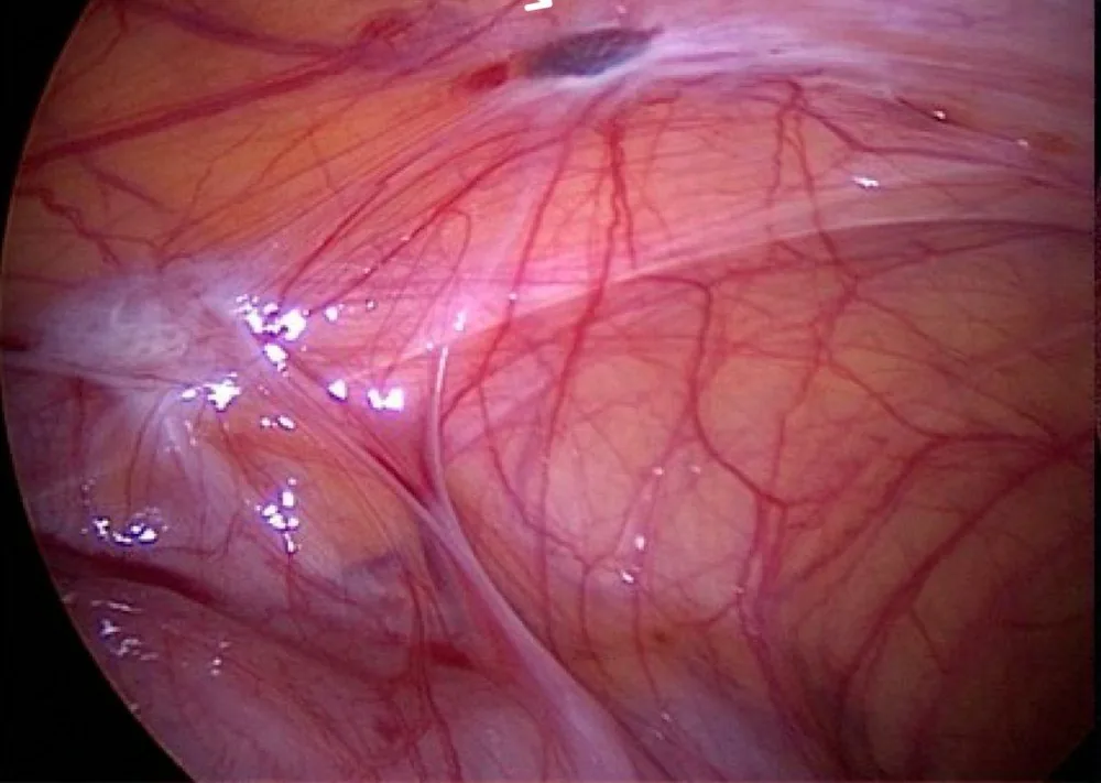 Endometriosis – Endoscopy & gross: HD laparoscopy: Superficial peritoneal endometriotic lesion