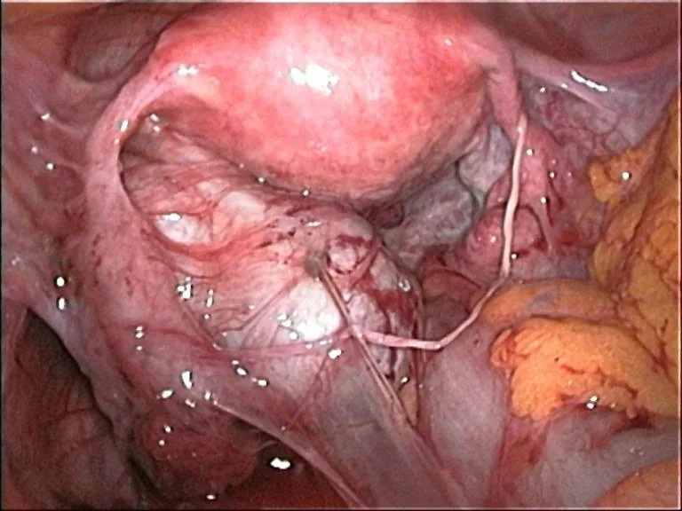 Endometriosis – Endoscopy & gross: Laparoscopy: Extensive adhesions with obliteration of the pouch of Douglas