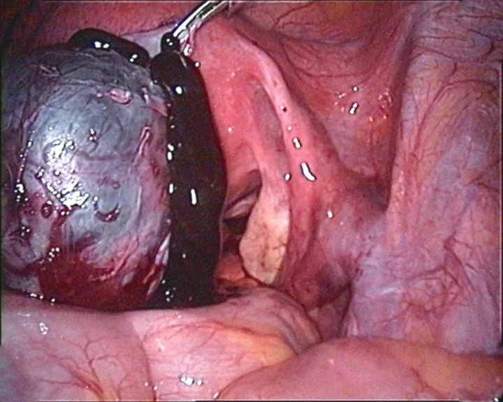 Endometriosis – Endoscopy & gross: Laparoscopy: opened chocolate cyst of the left ovary with old, tar-like blood