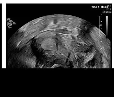 Endometriumhyperplasie – Sonographie: Transvaginalsonographie: Endometrium 22,8 mm bei atypischer Endometriumhyperplasie