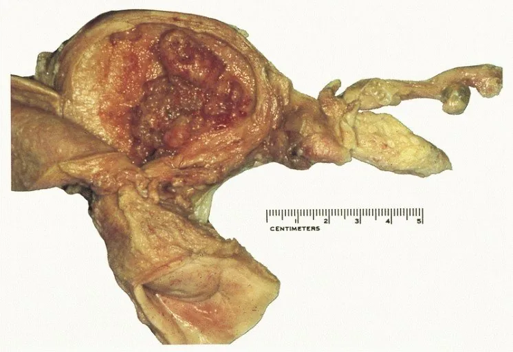 Endometriumhyperplasie – Endoskopie & Makro: Uteruspräparat: verdicktes, körnig-polypoides Endometrium bei Endometriumhyperplasie
