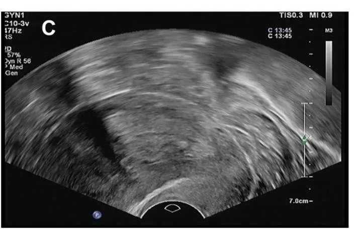 Endometriumhyperplasie – Sonographie: Transvaginalsonographie: diffus verdicktes, inhomogenes Endometrium ohne umschriebenen Herd — Hyperplasie