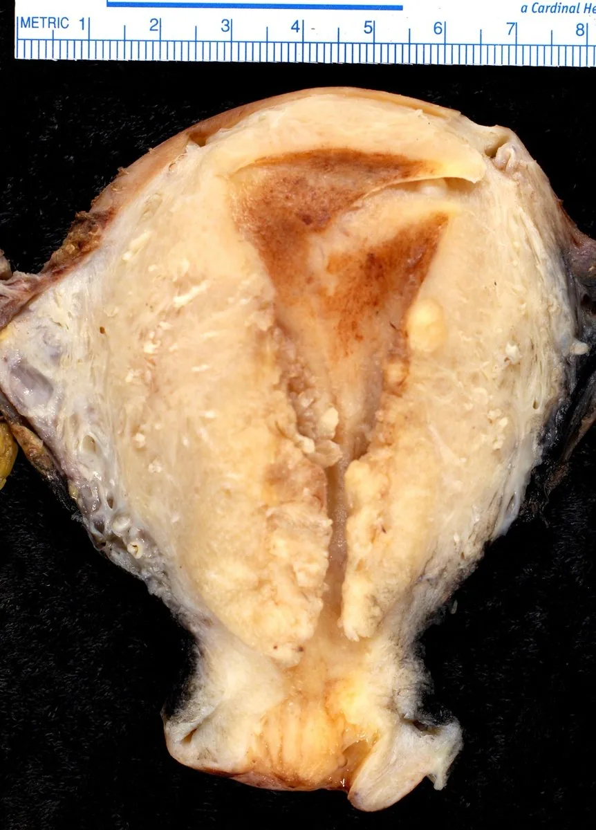 Endometriumkarzinom – Endoskopie & Makro: Uteruspräparat, aufgeschnitten: Endometriumkarzinom mit Myometriuminvasion