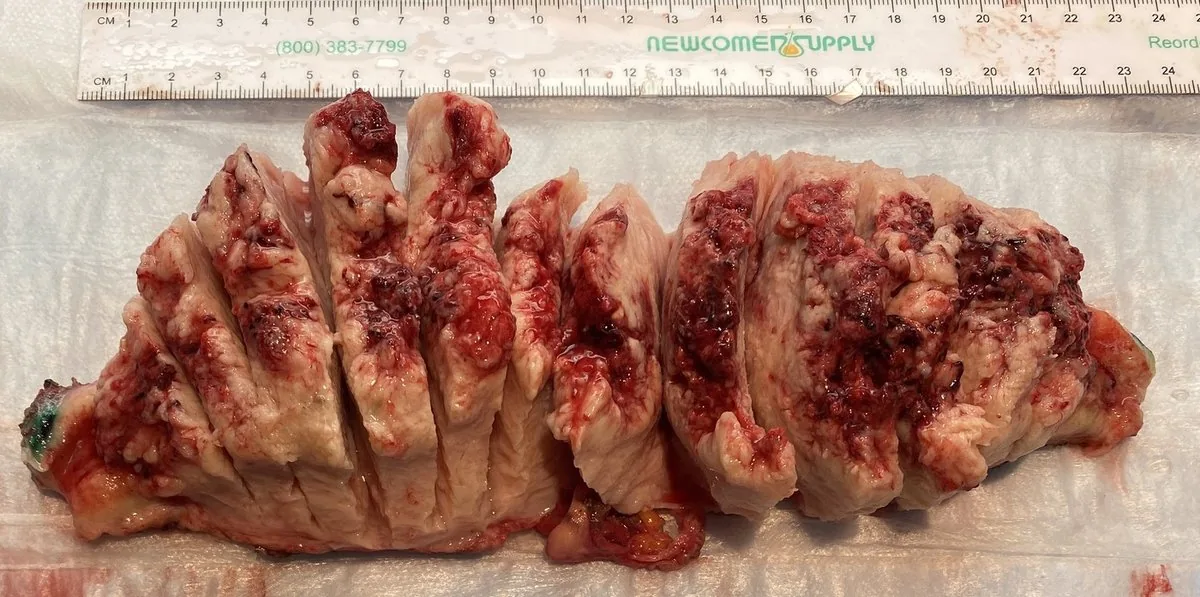 Endometriumkarzinom – Endoskopie & Makro: Uteruspräparat, lamelliert: ausgedehntes, hämorrhagisch-nekrotisches Endometriumkarzinom