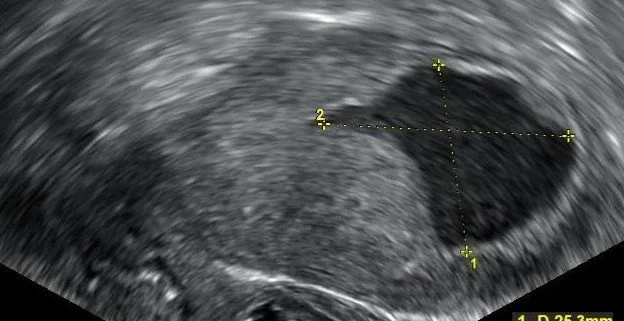 Endometriumkarzinom – Sonographie: Transvaginalsonographie bei Postmenopausenblutung: dünnes, atrophes Endometrium