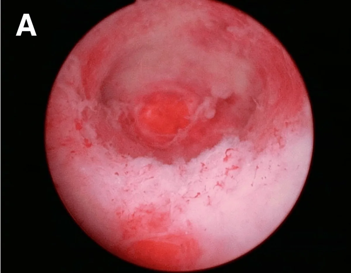 Endometriumkarzinom – Endoskopie & Makro: Hysteroskopie: flache, kartenartige, nicht transluzente weißliche Läsion — Endometriumkarzinom G2