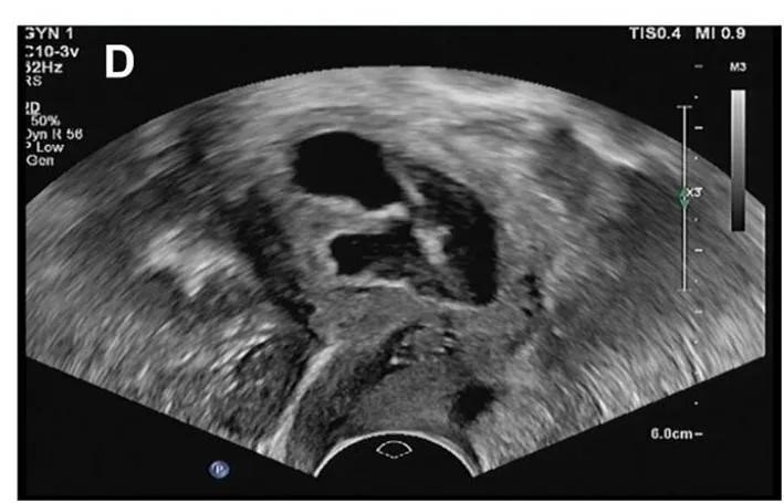 Endometriumkarzinom – Sonographie: Transvaginalsonographie: Flüssigkeitsansammlung im Cavum uteri postmenopausal