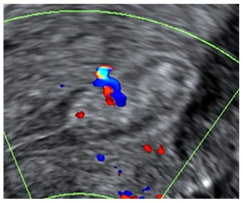Endometrial polyp – Ultrasound: Transvaginal ultrasound with power Doppler: endometrial polyp with a single feeder vessel
