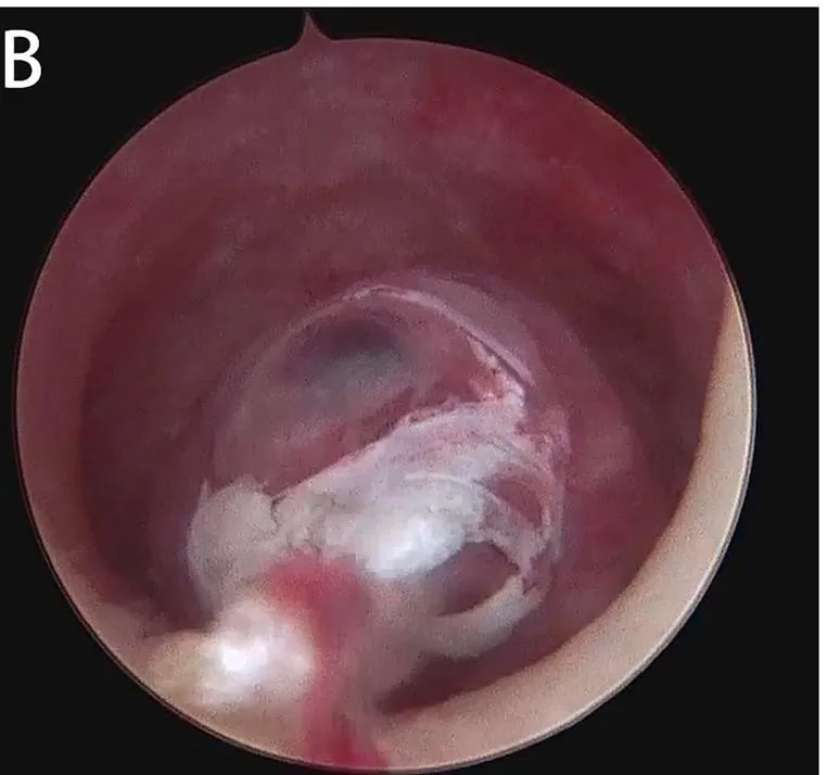 Endometrial polyp – Endoscopy & gross: Hysteroscopy: large endometrial polyp in a postmenopausal patient
