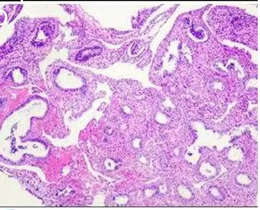 Endometrial polyp – Histology & cytology: Histology (H&E) of an endometrial polyp