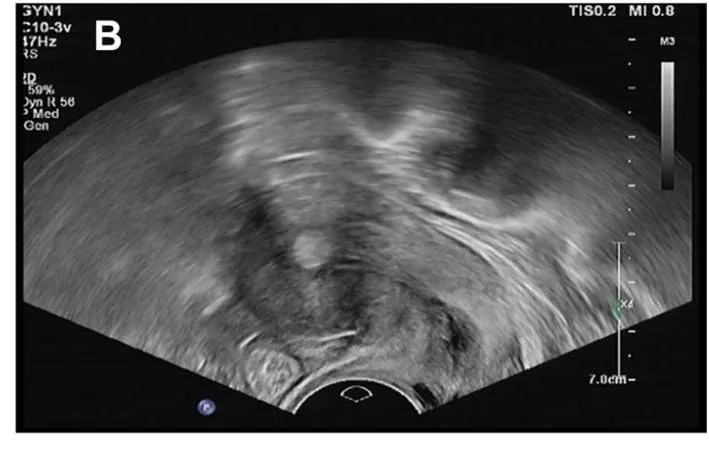 Endometrial polyp – Ultrasound: Transvaginal ultrasound: circumscribed, cystic mass, clearly demarcated from the myometrium — polyp