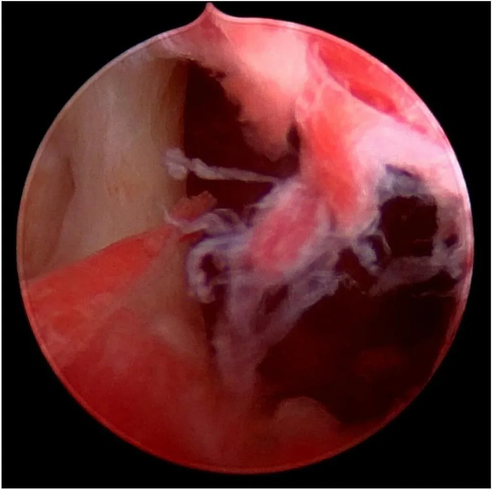 Endometrial polyp – Endoscopy & gross: Hysteroscopy: dense synechia between the anterior and posterior walls — Asherman's syndrome
