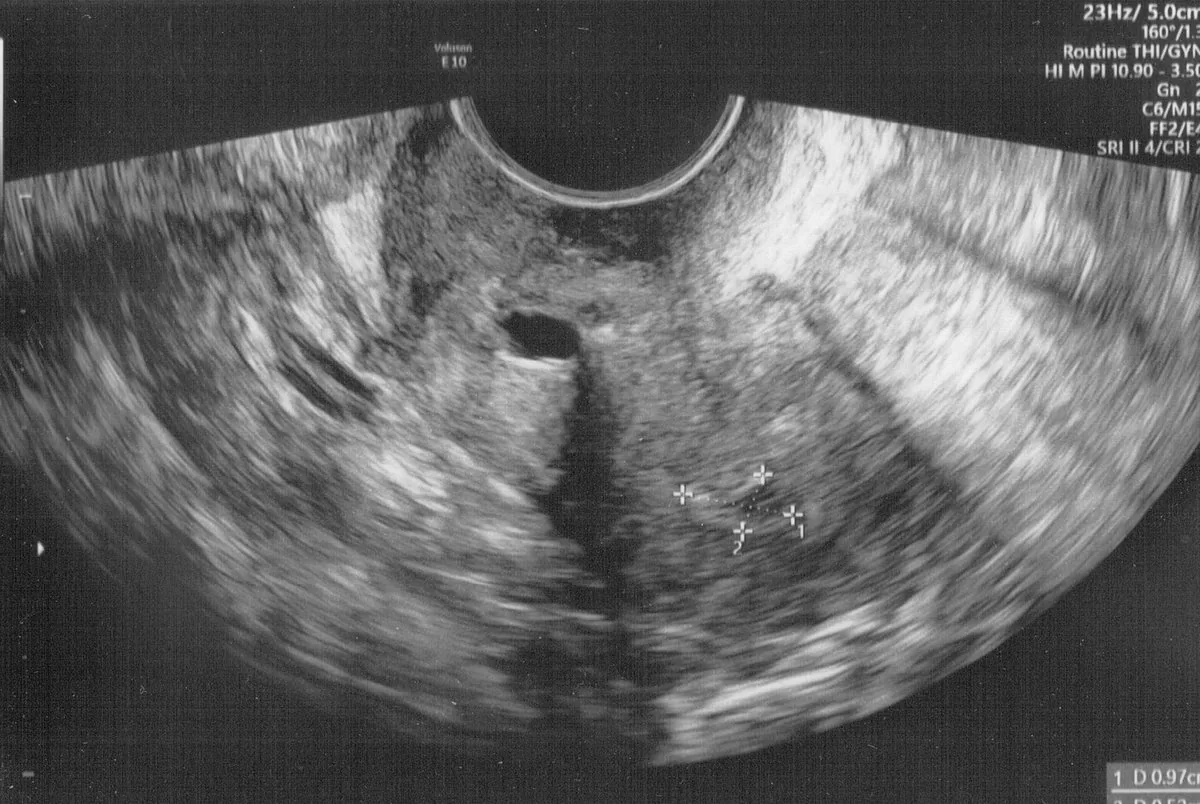 Endometrial polyp – Ultrasound: Endometrial polyp