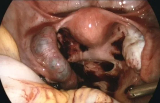 Ectopic pregnancy – Endoscopy & gross: Laparoscopic view of a tubal pregnancy — a bluish distended tube with haematosalpinx