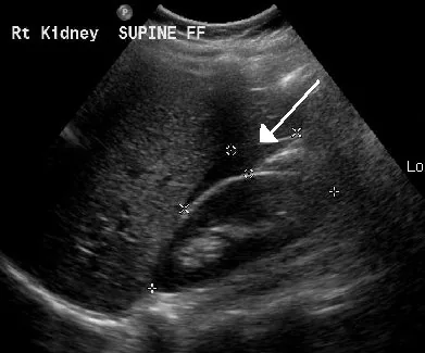 Ectopic pregnancy – Ultrasound: Free fluid in Morison’s pouch — haemoperitoneum in a ruptured ectopic pregnancy