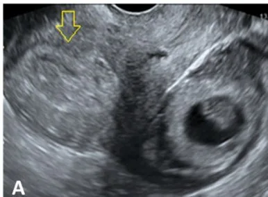 Ectopic pregnancy – Ultrasound: Tubal ring or bagel sign: a round mass beside the uterus with an echogenic rim, alongside a decidualised endometrium (Photo: J Clin Med (MDPI) 2026 (PMC12842302), open access, CC BY 4.0)