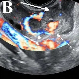 Ectopic pregnancy – Ultrasound: Ring of fire: a bright circular colour Doppler ring around an extrauterine sac (here an ovarian pregnancy) (Photo: Arch Gynecol Obstet 2026 (PMC13337687), open access, CC BY 4.0)