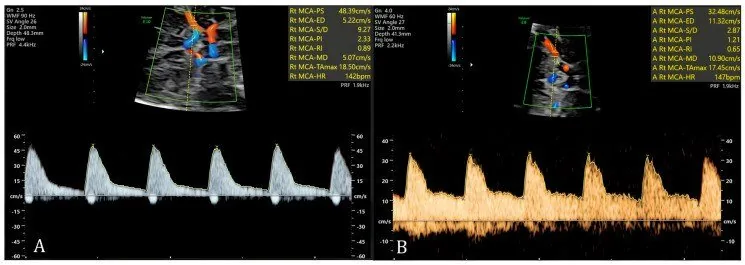 Fetale Anämie – Sonographie: A. cerebri media im Vergleich: normaler Pulsatilitätsindex (A) gegen Brain sparing mit vermehrtem diastolischem Fluss (B) (Foto: Sá MI, Illa M, Guedes-Martins L. (Diagnostics (Basel, …