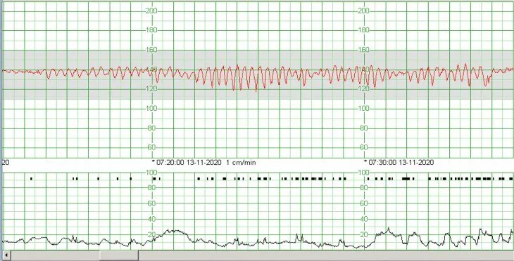 Fetale Anämie – CTG: Sinusoidales Muster: regelmäßige, glatte Wellen um 130–140 bpm über mehrere Minuten bei massiver fetomaternaler Transfusion