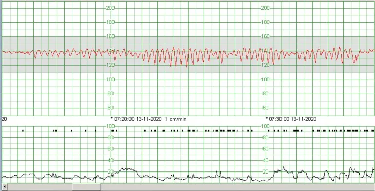 Fetale Anämie – CTG: sinusoidales Muster