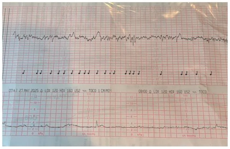 Fetale Hypoxie und Azidose – CTG: Normales CTG nach FIGO: Baseline um 140 bpm, normale Variabilität, keine Dezelerationen