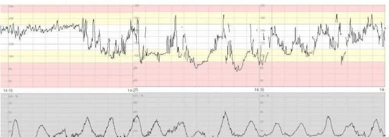Fetale Hypoxie und Azidose – CTG: Variable Dezelerationen in der Eröffnungsperiode — wechselnde Form und wechselnder Bezug zur Wehe
