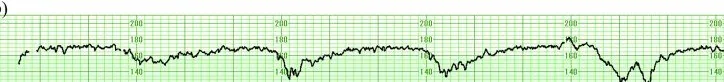 Fetale Hypoxie und Azidose – CTG: Späte Dezelerationen bei tachykarder Baseline um 170 bpm