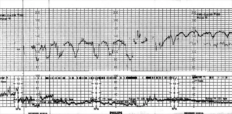 Fetale Hypoxie und Azidose – CTG: Prolongierte Dezeleration mit tiefer Bradykardie